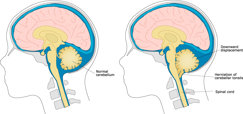 Chiari-Malformation